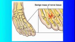 Mortons Neuroma [upl. by Civ976]