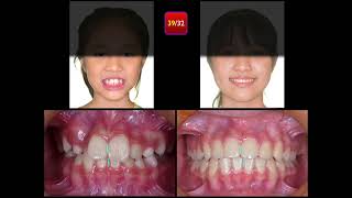 Molar Ankylosis｜【Chris Chang Ortho】CC796 [upl. by Yllil]