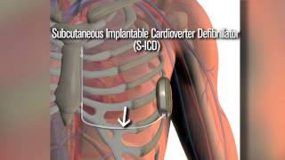 New SICD defibrillator a safety net for cardiac patients [upl. by Margetts]