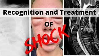 Recognition and Treatment of Shock [upl. by Alley523]