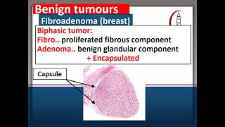 Neoplasia Benign Tumors [upl. by Oidgime]