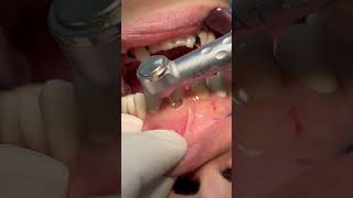 Cleaning deep tooth caries dental [upl. by Ayotnom]