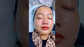 This Freckle Treatment is viral on YouTube Kwakeithel Imphal Manipur [upl. by Ylrebme621]