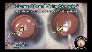 CataractCoach™1794 Eyhance Right Eye and Vivity Left Eye  Why [upl. by Cicily]