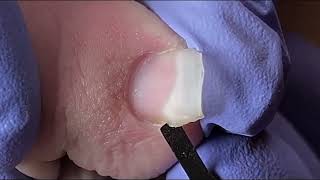 Ingrown Toenail Removal  Pedicure Treatment and Very Satisfying  Best Satisfying Nail Cutting [upl. by Pelagi]