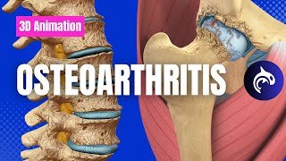 Understand Osteoarthritis  OA of the Knee Spine Hip Hand Elbow and more [upl. by Ozzie]