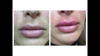 Juvederm Lips by Anusha in West LA [upl. by Adne]