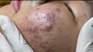 loan nguyen acne treatment amp Blackheads removal [upl. by Alemak]