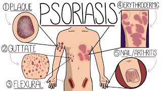 Psoriasis Explained Clearly  Including Types and Treatment [upl. by Nata]