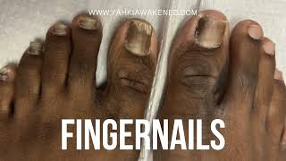 HEALING TOENAILFINGERNAIL FUNGUS 🦶🏿 [upl. by Alodi16]