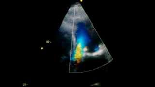 Aortic regurgitation in echocardiography [upl. by Ahsetra220]