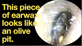 This piece of earwax looks like an olive pitear wax removal  ear cleaning  ASMR  relaxation [upl. by Purdy894]