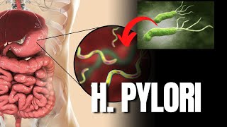 Entendendo o H pylori Causas Sintomas e Estratégias de Tratamento  Nutri Rodrigo Moreira [upl. by Emoryt615]