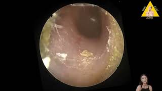 Ear wax removal with camera Yellow ear wax How does ear wax form OtoSet® Ear Cleaning [upl. by Disraeli893]