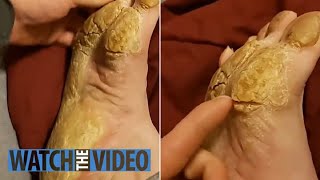 Removing Extremely Hard Foot Callus 🦶 The right way to remove foot callus FULL TREATMENT 08 [upl. by Nit]