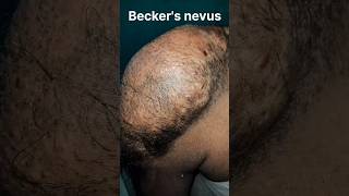 Beckers nevus with smooth muscle hamartoma 😱 shorts skincare shortsfeed viral [upl. by Stephine870]