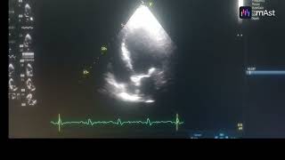 HYPOKINESIA OF ANTERO SEPTUM APICAL SEPTUM AND APEX MODERATE TO SEVERE LV MILD MR [upl. by Rosel]