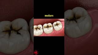 Molar teeth damaged by caries dentist healthandfitness [upl. by Aufa]