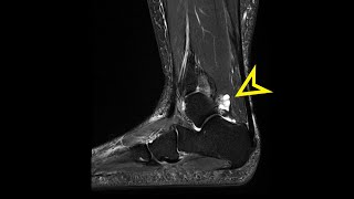 Ankle MRI Ganglion Cyst [upl. by Artined]