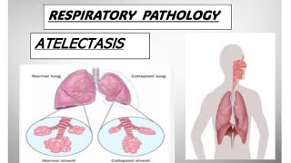 Respo pathology  ATELECTASIS and its types atelectasis copd pathology [upl. by Ahsilla]