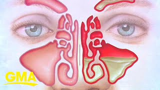 How to treat sinus infection symptoms at home [upl. by Towrey]