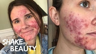 Going Out With My Severe Acne For The First Time  SHAKE MY BEAUTY [upl. by Yenreit282]