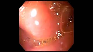 Normal oesophagogastroscopyDuodenitis withduodenal ulcer [upl. by Aniles]