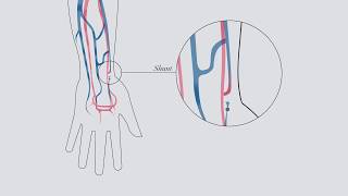 Understanding hemodialysis [upl. by Aihsercal421]