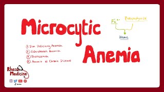 MICROCYTIC ANEMIA Iron Deficiency Anemia Anemia of Chronic Disease Sideroblastic Anemia  Rhesus [upl. by Eittol]