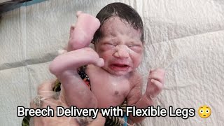 Breech delivery of Newborn baby with Flexible Legs just after birth [upl. by Forrer]