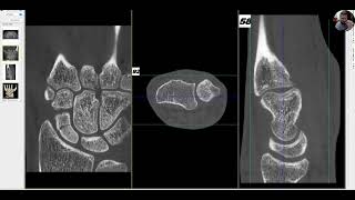 Fractura del escafoides del carpo muñeca [upl. by Doelling]