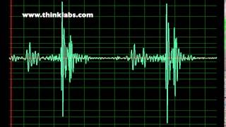 Right Bundle Branch Block slow [upl. by Mosa]