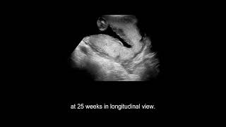 Placental Abnormalities vasa previa morbidly adherent placenta placental abruption [upl. by Greenland]