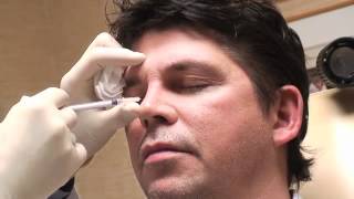 Permanent NonSurgical Rhinoplasty With Dr Robert Kotler [upl. by Dilks]