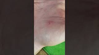 Pulling out the splinter with a sewing needle How to get rid of a splinter [upl. by Minsat]