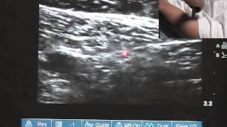 Ultrasound Guided Saphenous Nerve Block  SSRAUSAcom [upl. by Ryan]