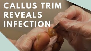 Callus Trim Reveals Infection [upl. by Sanoy]