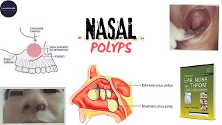 NASAL POLYPANTROCHOANALETHMOIDALETIOLOGYSSTREATMENT dhingra otorhinolaryngology udaipurwala [upl. by Uyr]