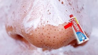 FIRST TIME USING Colgate to Remove Blackheads amp Whiteheads From Your Nose  REMOVES EVERYTHING [upl. by Yna]