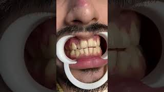 scaling amp polishingCapCut viralmyaccount🙏🙏😚😘 viralvideos dentistaentiktok [upl. by Laina]