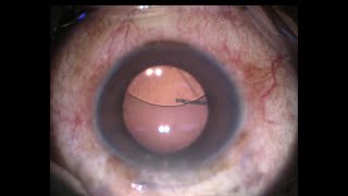 PPV Double Flanged Scleral Fixation of Posterior Dislocated PMMA IOL [upl. by Fancie]