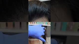 15min miracle 15분기적 hairloss 두피커버링 scalp Scalp Covering [upl. by Konyn143]