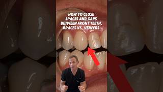 How to close spaces and gaps between front teeth Braces vs veneers dentist wichita veneers [upl. by Weismann664]