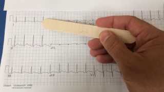 pericarditis on EKG [upl. by Ennywg929]