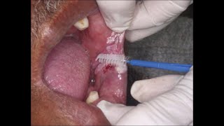 ORAL EXFOLIATIVE CYTOLOGY ORAL CYTOLOGY TECHNIQUE ORAL SCREENING PROCEDURE ORAL CANCER SCREENING [upl. by Bauer129]