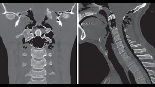 Idiopathische kraniozervikale Hyperpneumatisation mit Pneumorrhachis [upl. by Mavra]