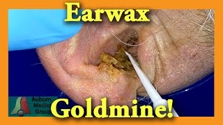 Earwax GOLDMINE  Auburn Medical Group [upl. by Hahseram]