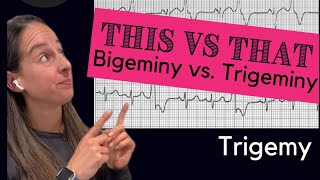 Bigeminy vs Trigeminy 🫀 [upl. by Sylvester]