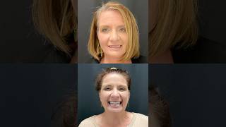 Smile Transformations You Need to See🤩🦷 allon4dentalimplants smilemakeover [upl. by Phylys]