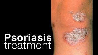 Psoriasis treatment options  related issues [upl. by Anilejna]